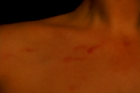 neck. The only strange thing about these bruises is that I'd been away from 